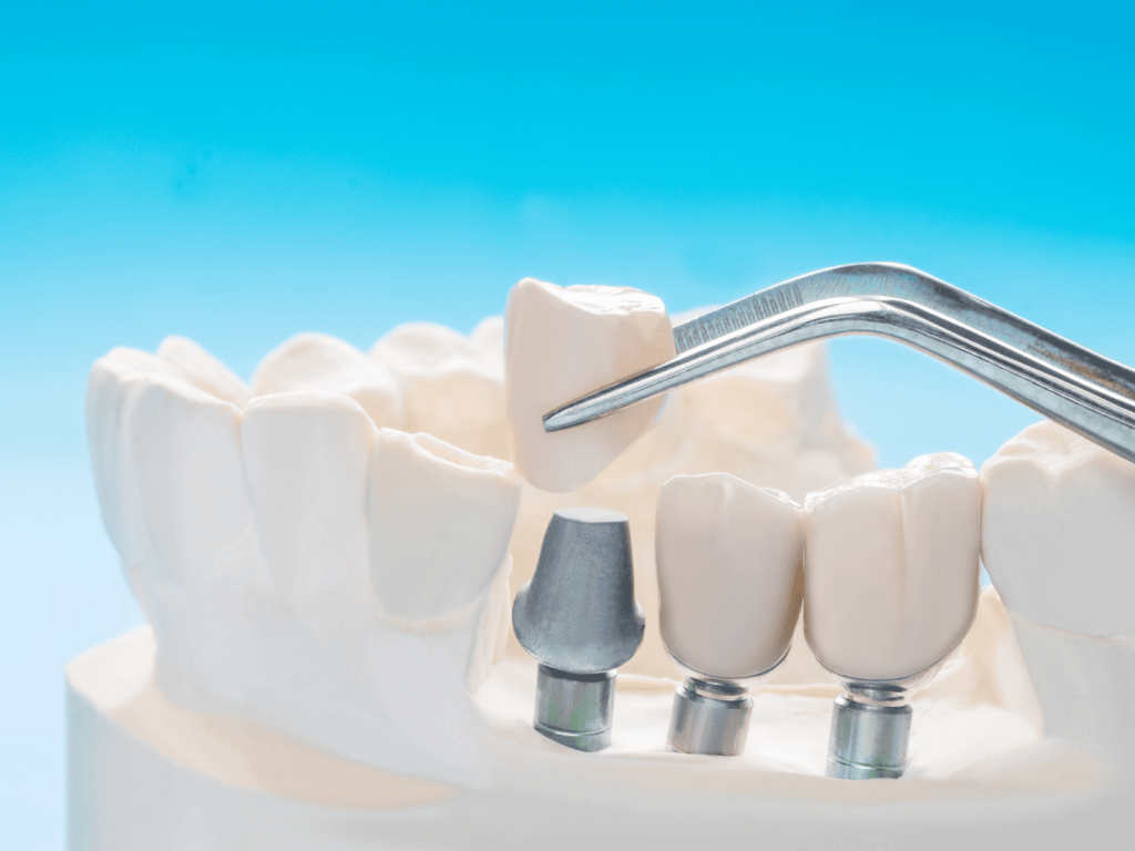 高雄All-on-4植牙-植牙優缺點