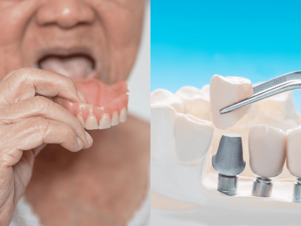 高雄植牙推薦-假牙與植牙選擇