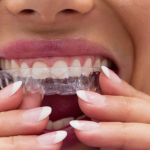 台北隱形矯正推薦-隱形牙套