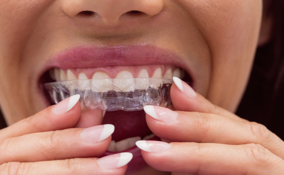 台北隱形矯正推薦-隱形牙套