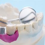 台北植牙推薦-植牙檢查