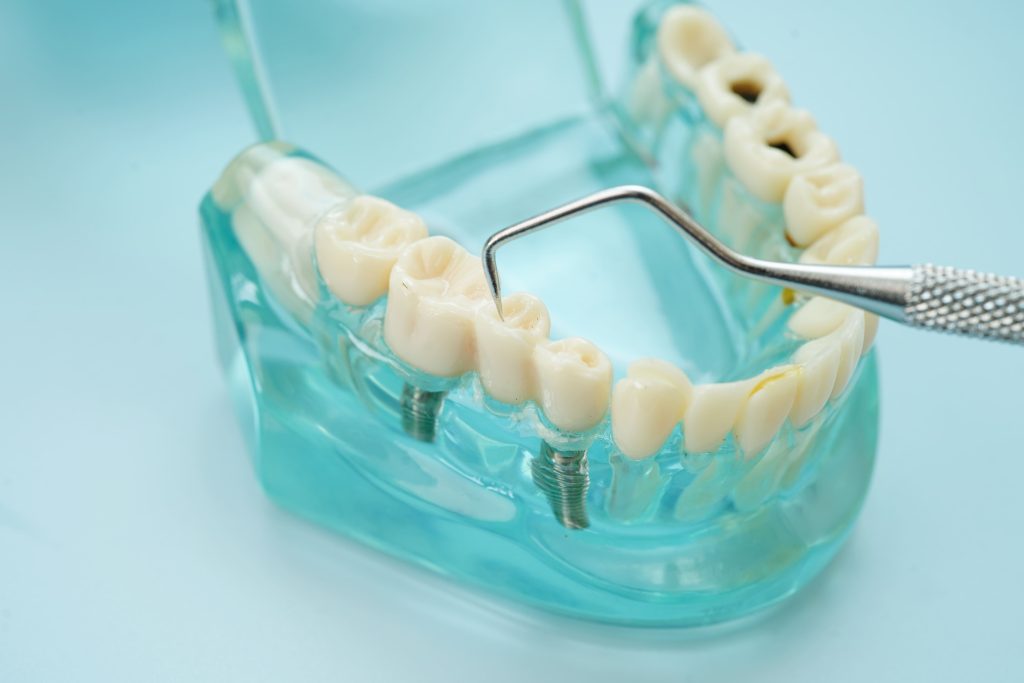 台北人工植牙推薦-植牙