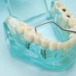 台北人工植牙推薦-植牙