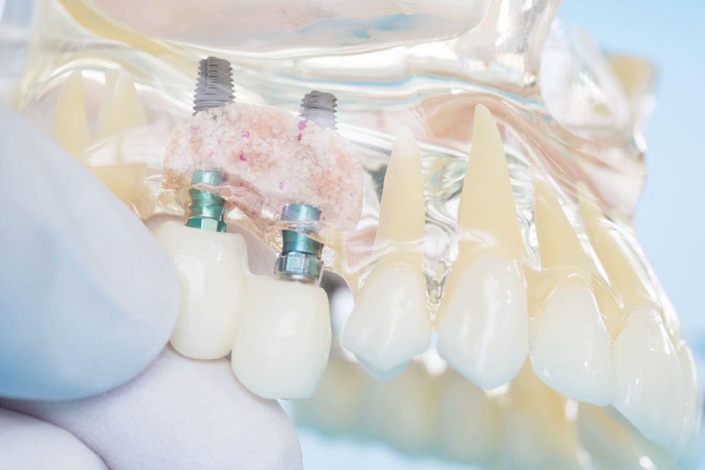 台北人工植牙推薦-植牙